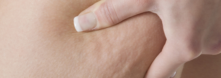 Zur Behandlung von hartn&auml;ckiger Cellulite setzt die Rosenpark Klinik das derzeit effektivste Verfahren ein: die Laserlipolyse.