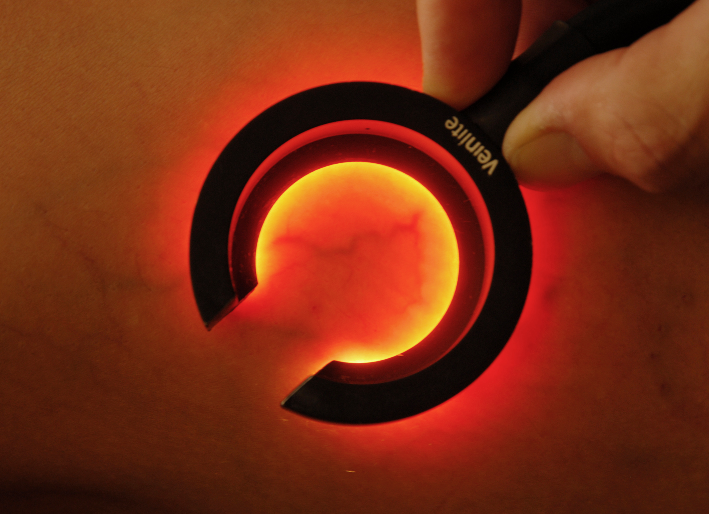Erg&auml;nzende Diagnose von Besenreisern und Krampfadern in der Rosenpark Klinik mit der Kaltlicht-Lupe Veinlite&reg;.