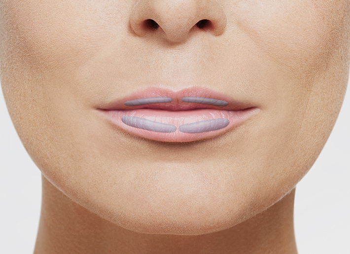 Die Lippen verlieren unausweichlich im Laufe der Jahre an Volumen und Gewebespannung. Mit viel Erfahrung in der Lippenbehandlung und einer schonenden Injektionstechnik geben die Experten der Rosenpark Klinik den Lippen natürliche Fülle und ihre schöne Die Lippen verlieren unausweichlich im Laufe der Jahre an Volumen und Gewebespannung. Mit viel Erfahrung in der Lippenbehandlung und einer schonenden Injektionstechnik geben die Experten der Rosenpark Klinik den Lippen natürliche Fülle und ihre schöne