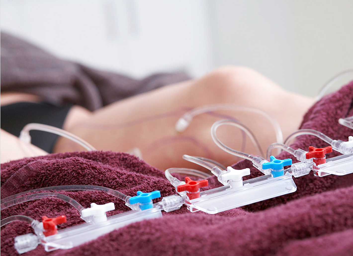 Gro&szlig;e Mengen Narkosel&ouml;sung werden f&uuml;r die Tumeszenz-Lokalan&auml;sthesie in der Rosenpark Klinik langsam und kontrolliert in das zu behandelnde Gewebe infiltriert.
