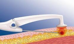 Die BodyTite&trade;-Kan&uuml;le strafft und saugt ab: Durch die Hitze ihrer Radiowellen zieht sich das Bindegewebe zusammen, zugleich verfl&uuml;ssigt sich &uuml;bersch&uuml;ssiges Fett, das umgehend abgesaugt wird.
