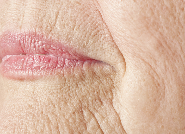 Mit flächig gespritzter Hyaluronsäure gewinnen Gesichtsmuskulatur und -haut wieder an Spannkraft. Eine Art Glow-Effekt, den die Experten der Rosenpark Klink mit Hyaluron Skin Booster und Deep Meso bewirken. Faltige Haut rund um der Mundpartie